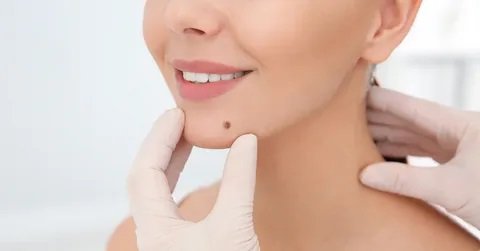 What Are the Side Effects of Mole Removal in Islamabad?